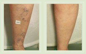 before-after-photos-varicose-spider-vein-leg-treatment-04