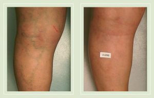 before-after-pictures-varicose-spider-vein-leg-treatment-03
