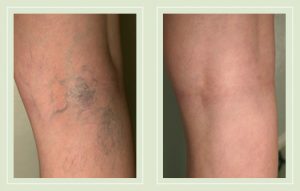 before-after-pictures-varicose-spider-veins-treatment-legs
