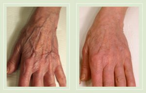 before-after-pictures-varicose-spider-vein-treatment-hands