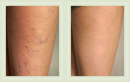 spider-vein-treatment-before-after-photos-pics-01