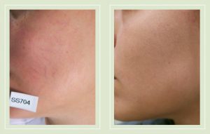 spider-veins-face-treatment-before-after-treatment-02