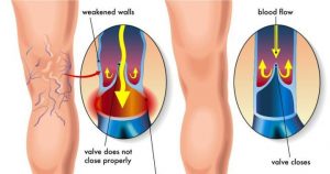 how-sclerotherapy-works-spider-varicose-vein-removal-nyc-03