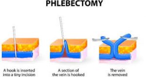 mini-phlebectomy-vein-treatment-nyc-05