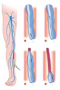 sclerotherapy-procedure-vein-removal-treatment-nyc-02