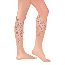 spider-varicose-veins-problem-on-legs-04