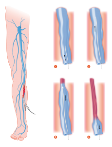 endovenous-laser-vascular-evlt-treatment-nyc-04