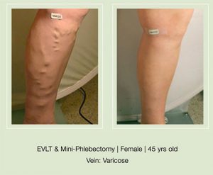 endonvenous_laser_ablation_evlt_treatment_before_after_pic_legs_woman