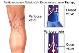 EVLT_laser_treatment Varicose_veins_clinic_NYC