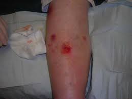 venous-ulcer-treatment-best-vein-dr-nyc-02