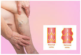 venous reflux laser treatment doctor nyc-02