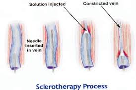 Sclerotherapy Treatment for Reticular Veins NYC