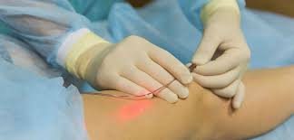 Best Laser Therapy for Vein Treatment 01