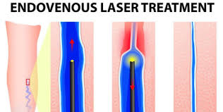 Endovenous Laser Ablation Therapy EVLT Vein Treatment