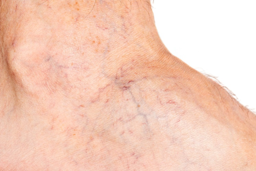 Cosmetic Vein Removal Doctors