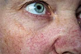 Causes of Broken Capillary Veins on Face