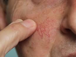 Spider veins on face | Best vein treatment center NYC