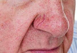 Spider veins on face causes | Vein Treatment Clinic NYC