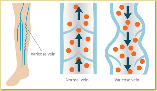 Varicose veins | Top vein treatment clinic NYC