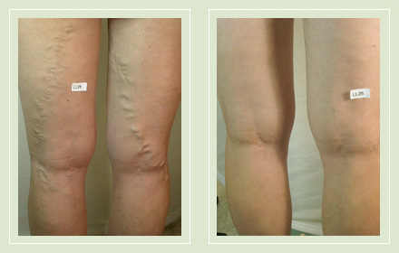 Best varicose veins treatment NYC | Before & after pics