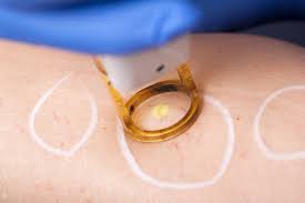 Laser treatment for vein removal vein clinic NYC 2023